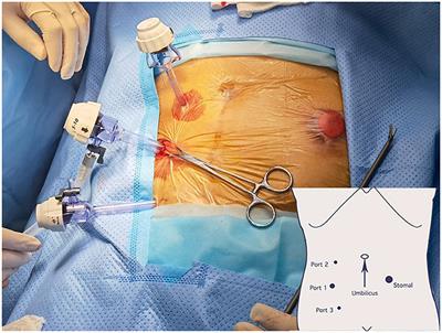 Frontiers Modified Laparoscopic Sugarbaker Repair Of Parastomal